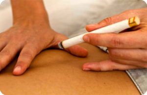 Moxibustion